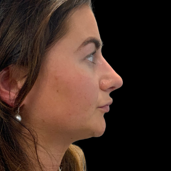 Ultrasonic-rhinoplasty-after